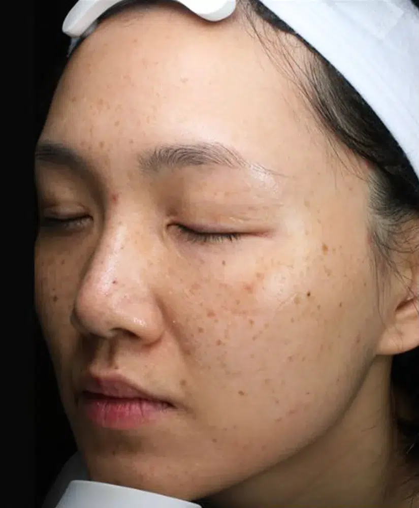 Freckles Before Treatment · Case 32 · Luowei Medical Aesthetics Clinic