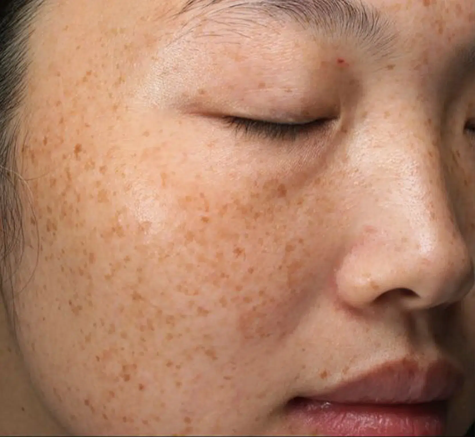 Freckles Before Treatment · Case 33 · Luowei Medical Aesthetics Clinic
