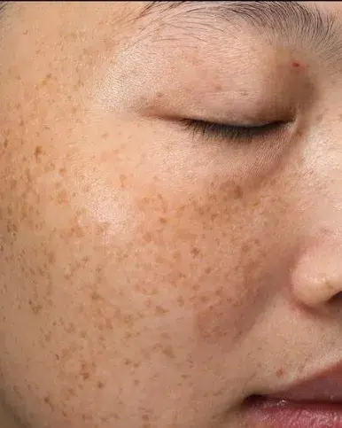 Freckles Before Treatment · Case 34 · Luowei Medical Aesthetics Clinic