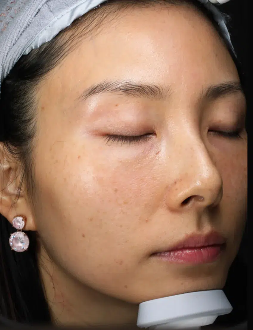 Freckles Before Treatment · Case 40 · Luowei Medical Aesthetics Clinic