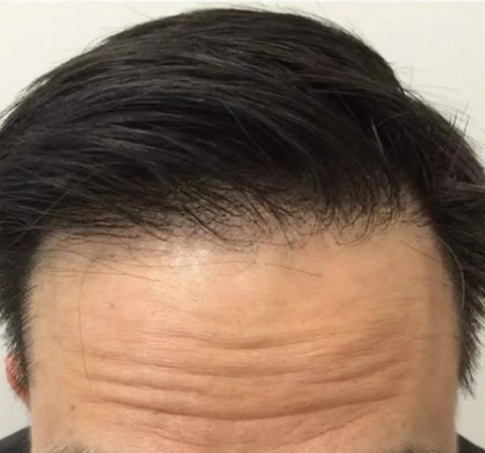 Hair Restoration Treatment — Before & After · Comprehensive Regeneration Program · Luowei Medical Aesthetics Clinic Nanjing · Case 01