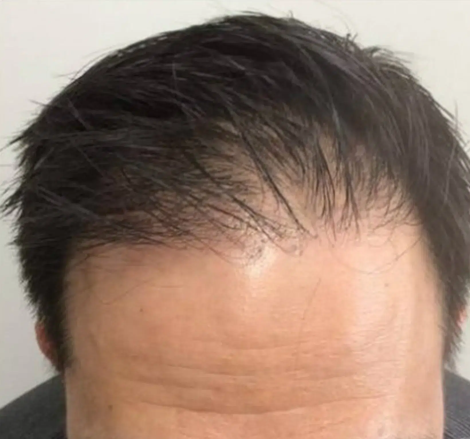 Hair Loss Treatment Before & After · Comprehensive Regenerative Plan · Luowei Medical Aesthetics Clinic Nanjing · Case 01