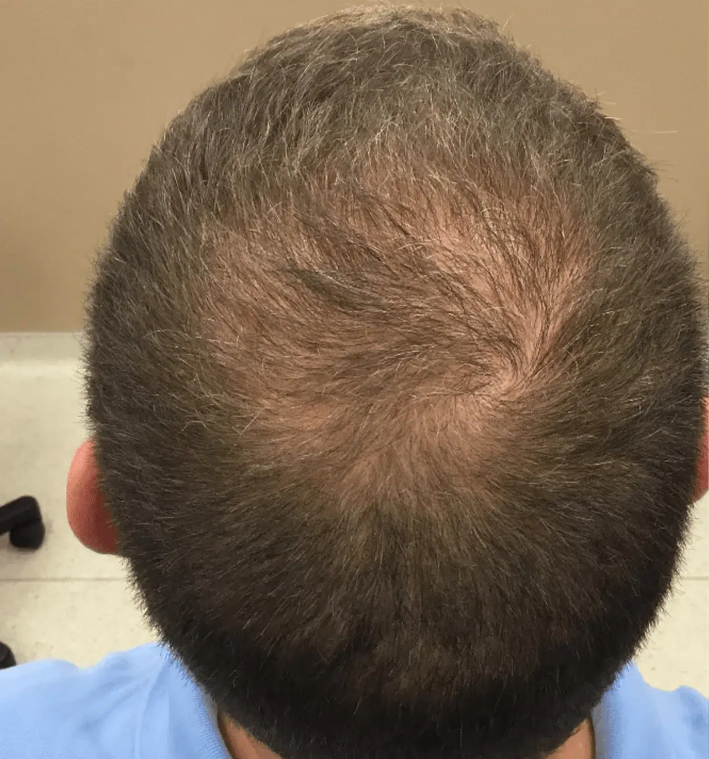 Hair Restoration Before & After — Thinning Hair · Scalp Regeneration · Luowei Medical Aesthetics Clinic Nanjing · Case 02
