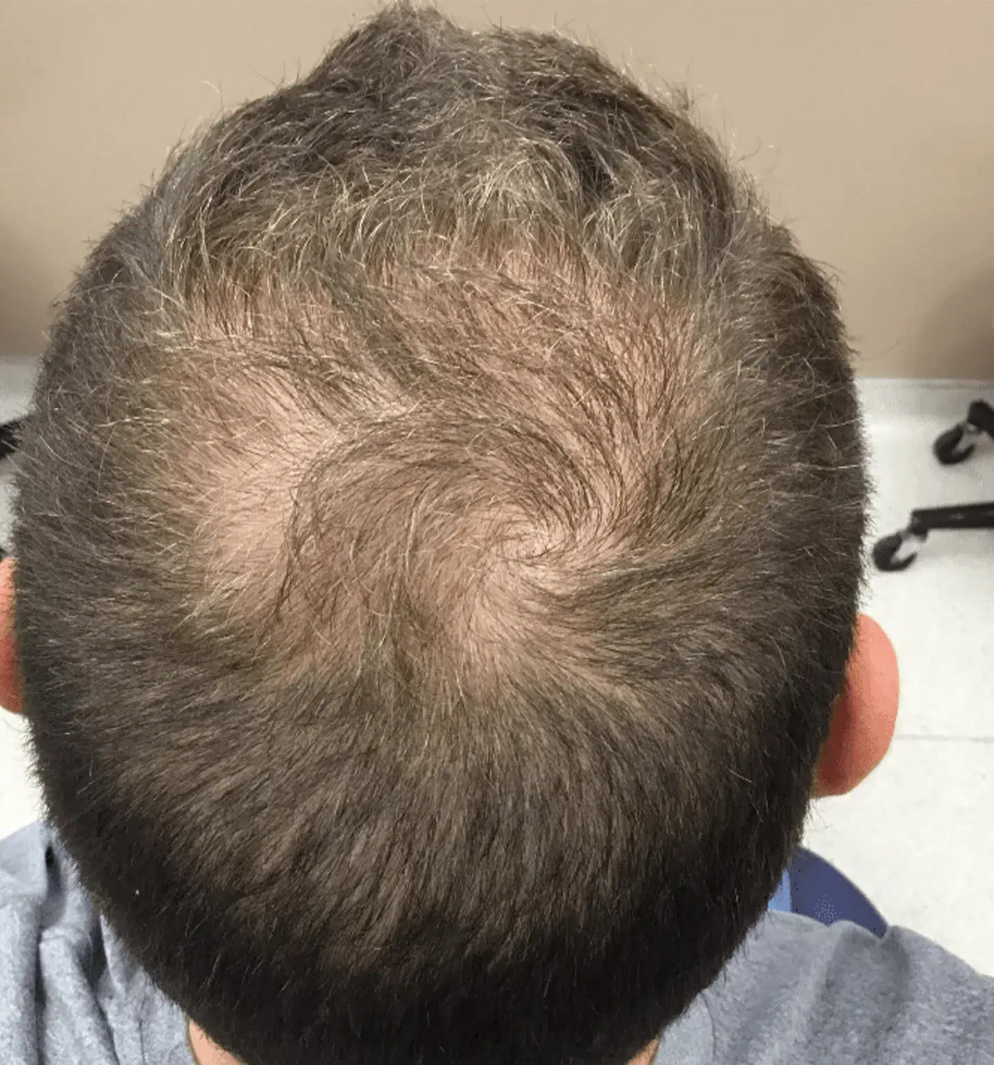 Hair Loss Treatment — Before & After · Scalp Regeneration · Luowei Medical Aesthetics Clinic Nanjing · Case 02
