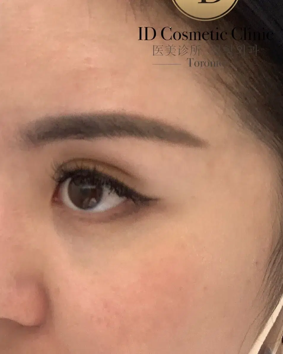 Hori's Nevus — After Treatment · Case 1 · Luowei Medical Aesthetics Clinic