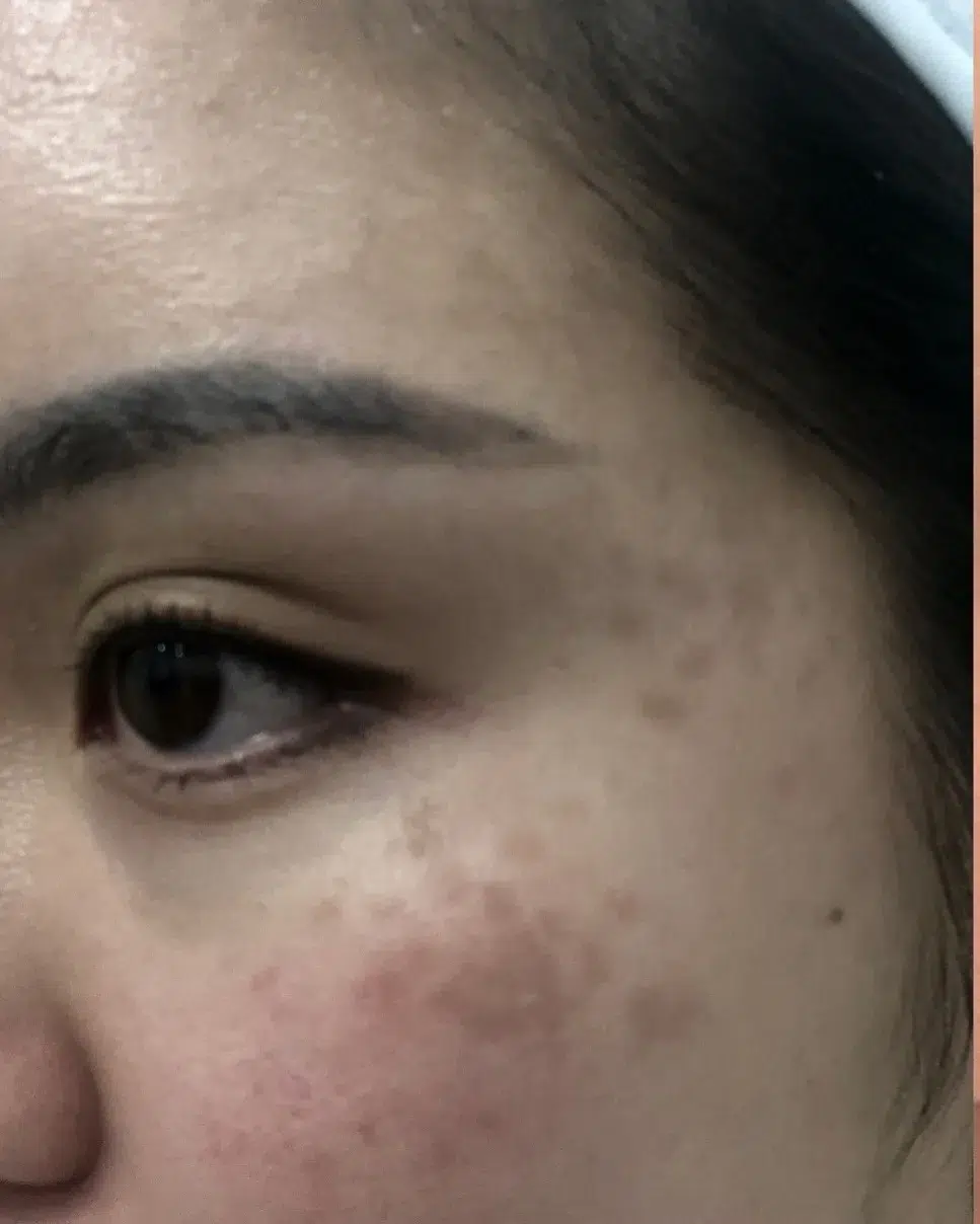 Hori's Nevus (ABNOM) — Before Treatment · Case 1 · Luowei Medical Aesthetics Clinic
