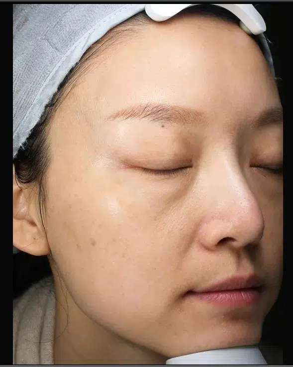 Freckles After Treatment · Case 09 · Luowei Medical Aesthetics Clinic