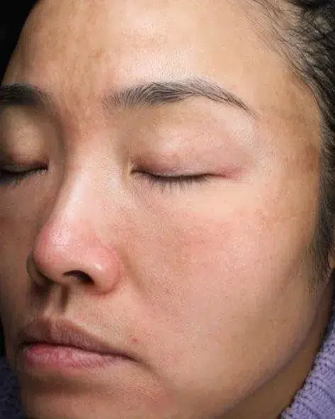 Pigmentation — After · Case 22 · Luowei Medical Aesthetics Clinic