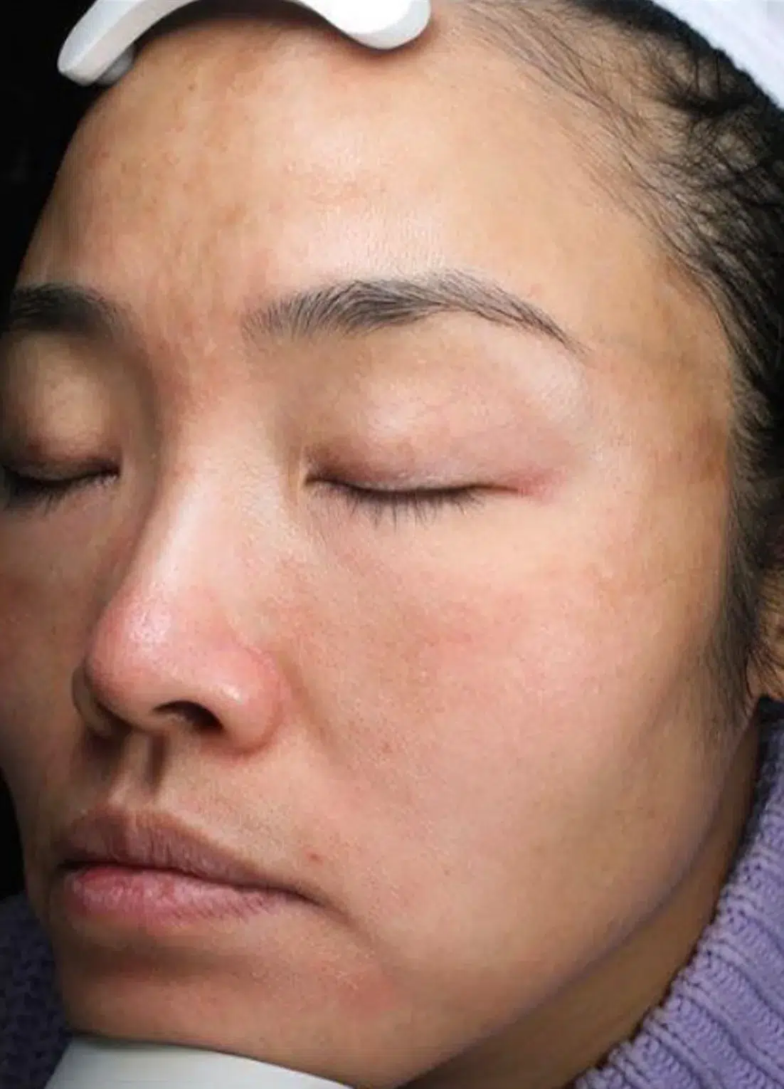 Melasma After Treatment · Case 11 · Luowei Medical Aesthetics Clinic