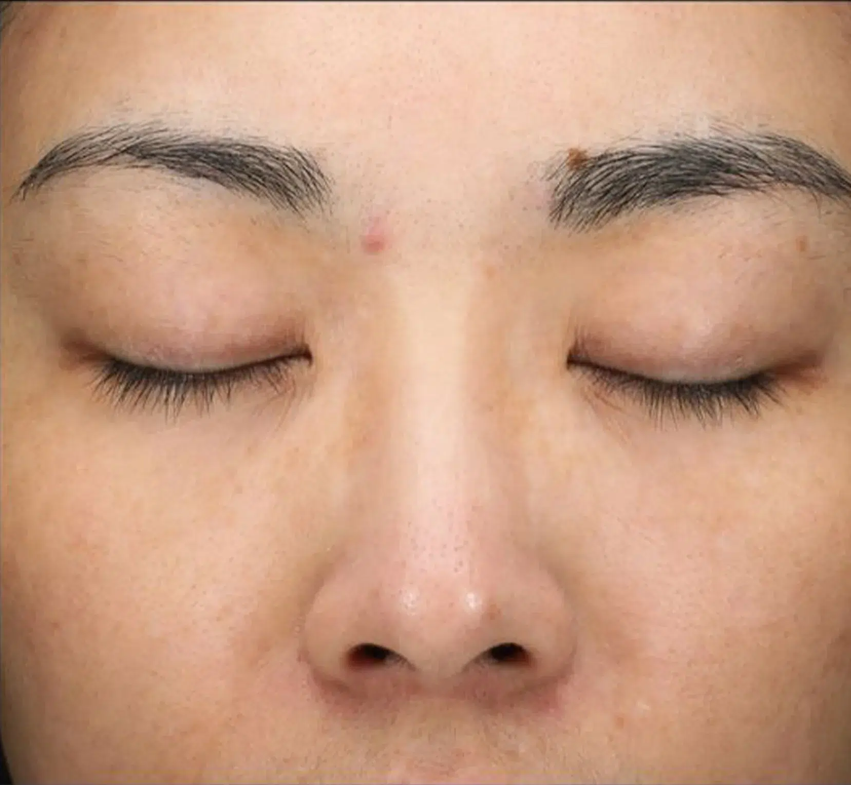 Freckles After Treatment · Case 12 · Luowei Medical Aesthetics Clinic