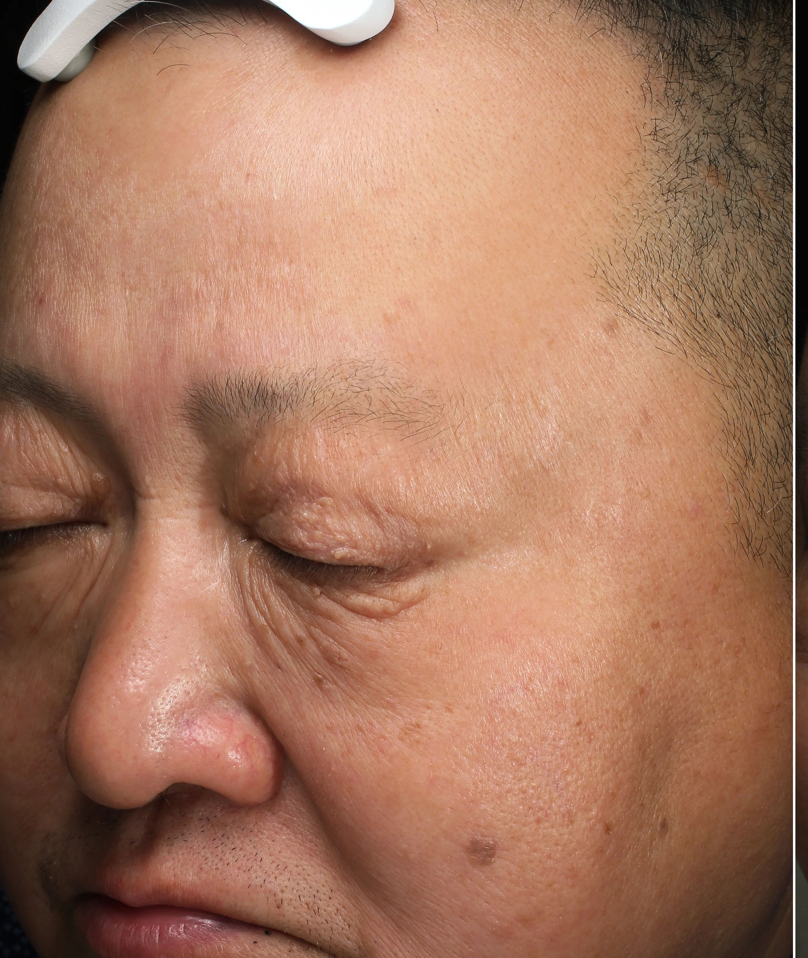 Freckles Before Treatment · Case 08 · Luowei Medical Aesthetics Clinic