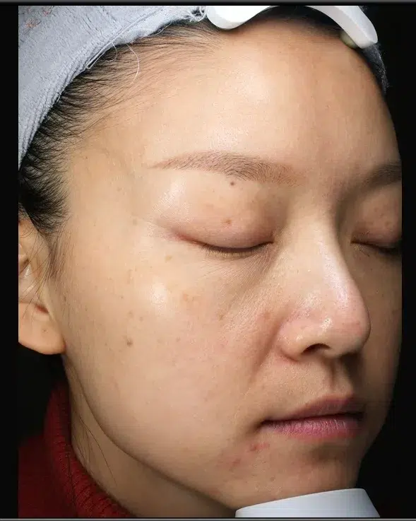 Freckles Before Treatment · Case 09 · Luowei Medical Aesthetics Clinic