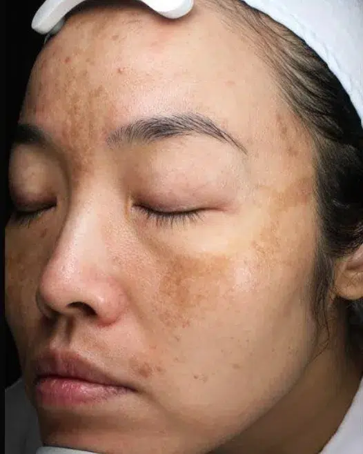 Pigmentation — Before · Case 22 · Luowei Medical Aesthetics Clinic