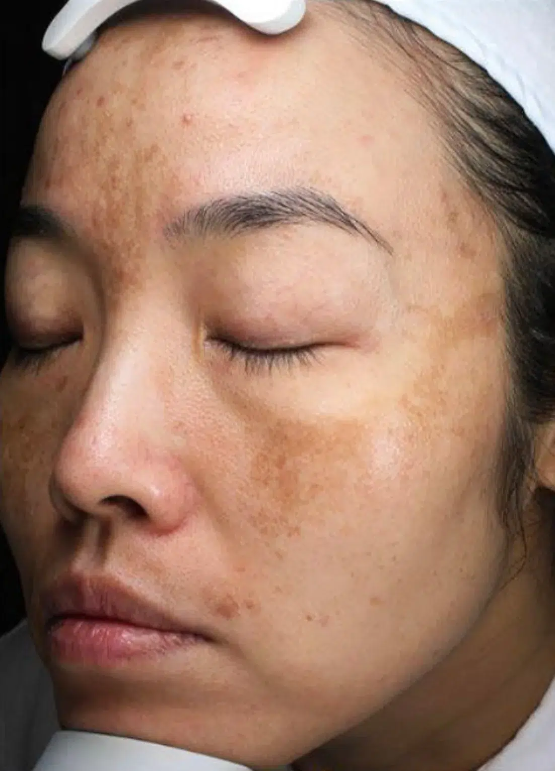 Melasma Before Treatment · Case 11 · Luowei Medical Aesthetics Clinic