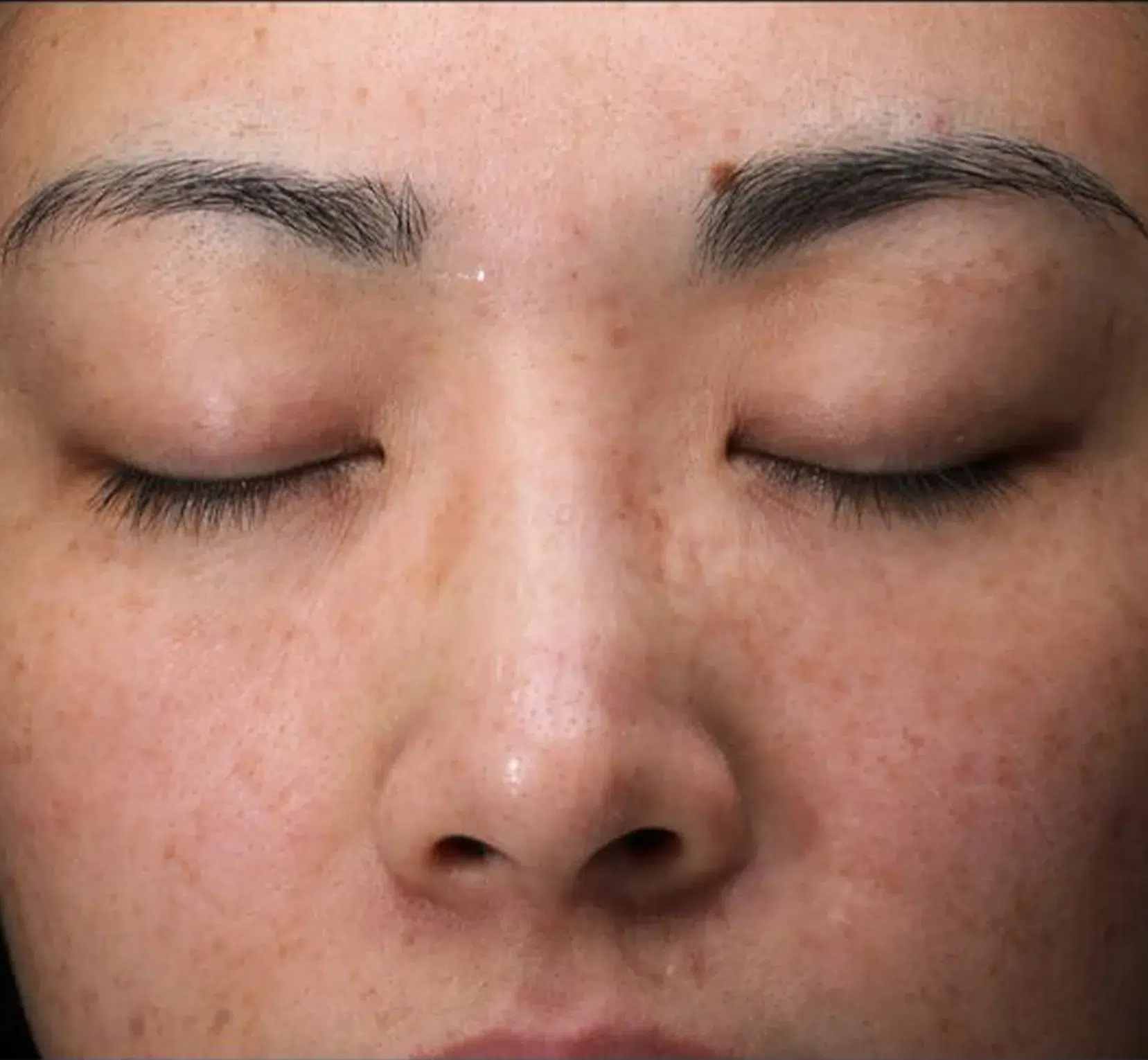 Freckles Before Treatment · Case 12 · Luowei Medical Aesthetics Clinic