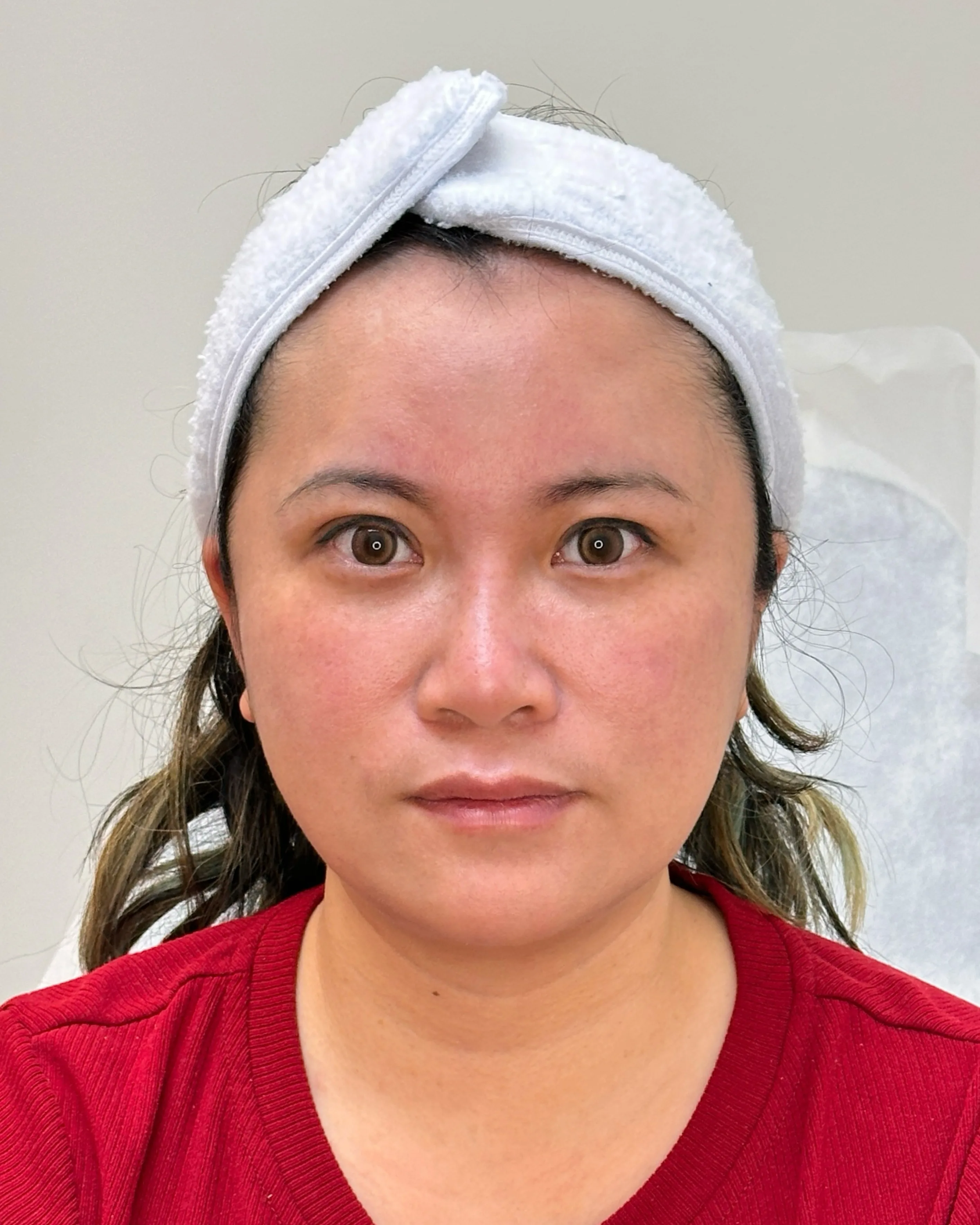 Freckles After Treatment · Case 14 · Luowei Medical Aesthetics Clinic