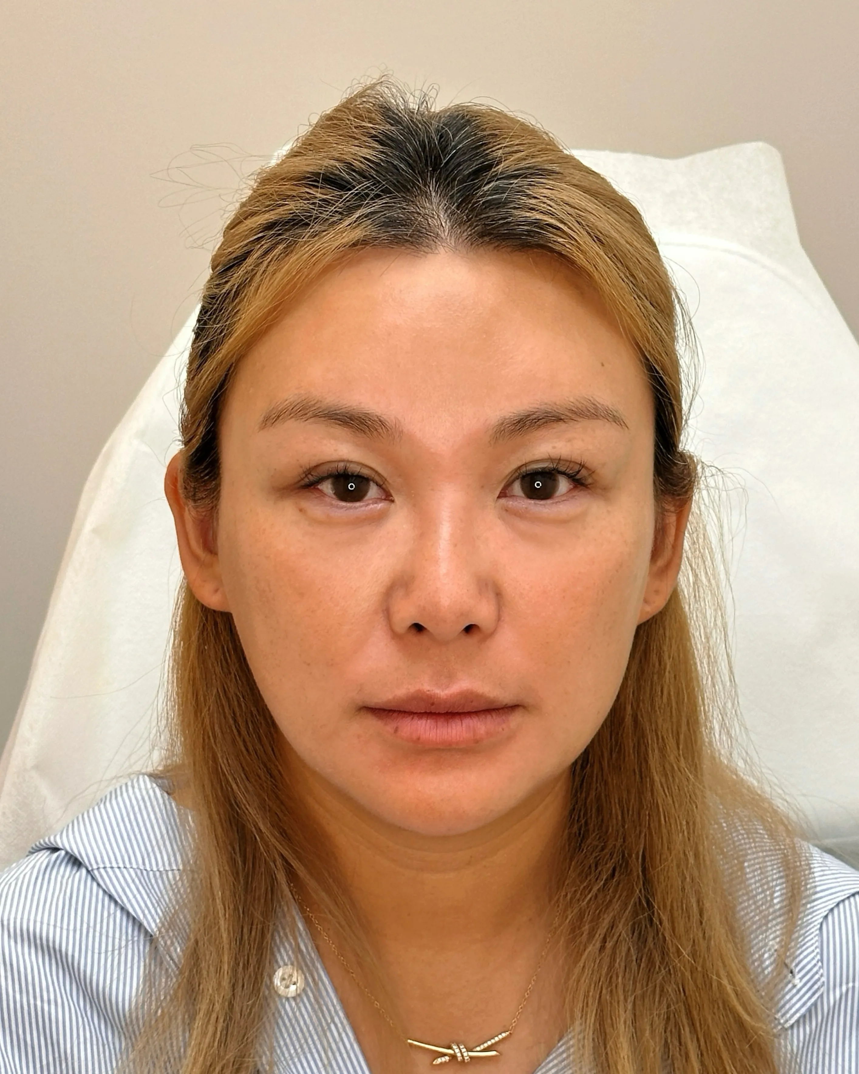 Luowei Bone-Structure Facial Sculpting, After · Case 47 · Luowei Medical Aesthetics Clinic