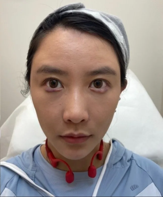Luowei Skeletal facial contouring · after · Case 51 · Luowei Medical Aesthetics Clinic