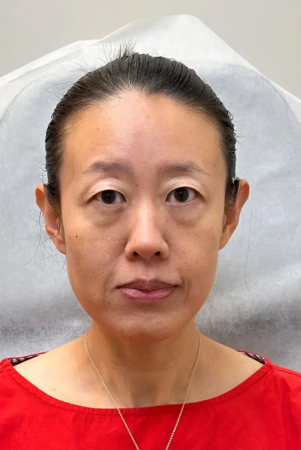 Luowei Bone-Structure Facial Contouring — Before · Case 9 · Luowei Medical Aesthetics Clinic