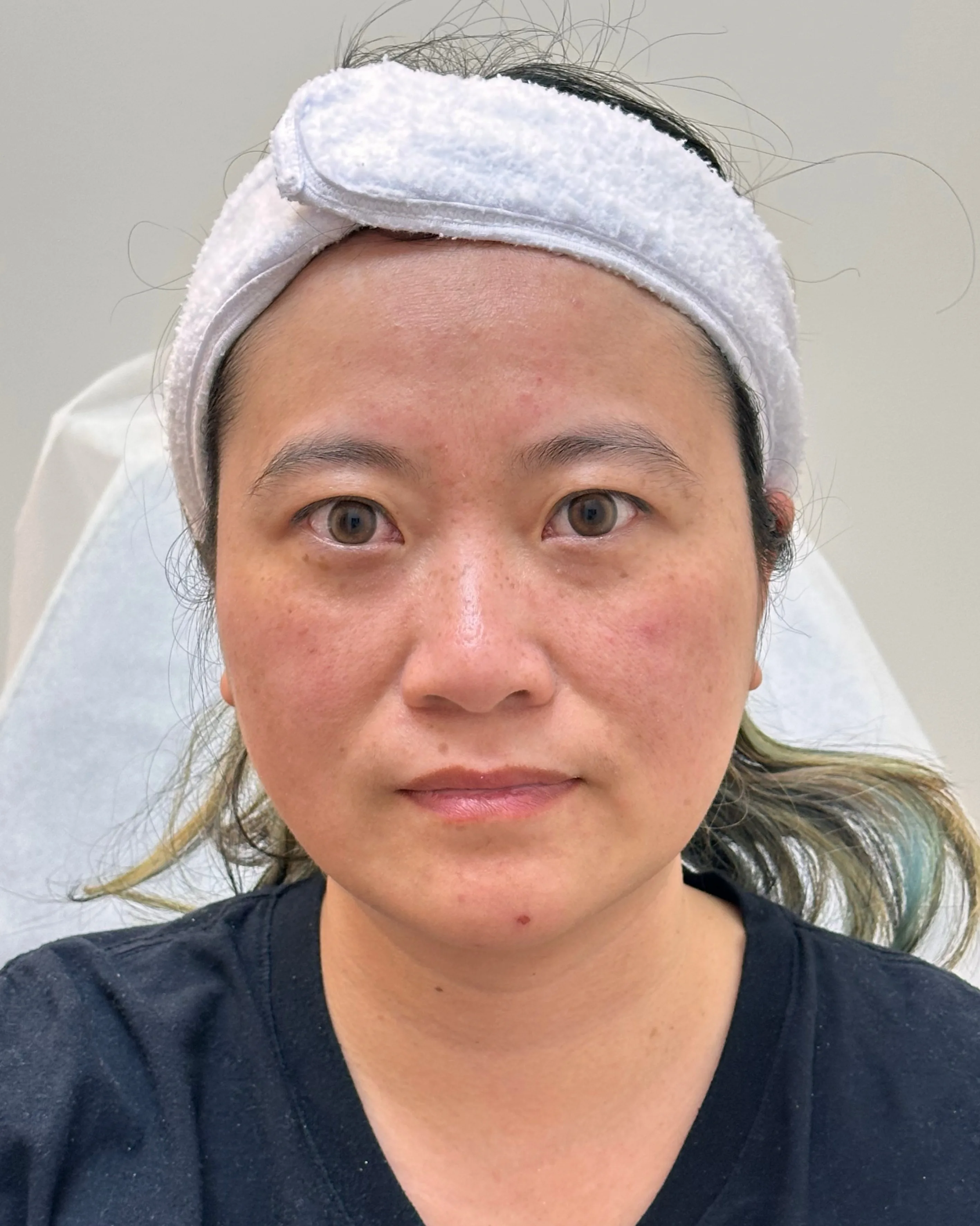 Freckles Before Treatment · Case 14 · Luowei Medical Aesthetics Clinic