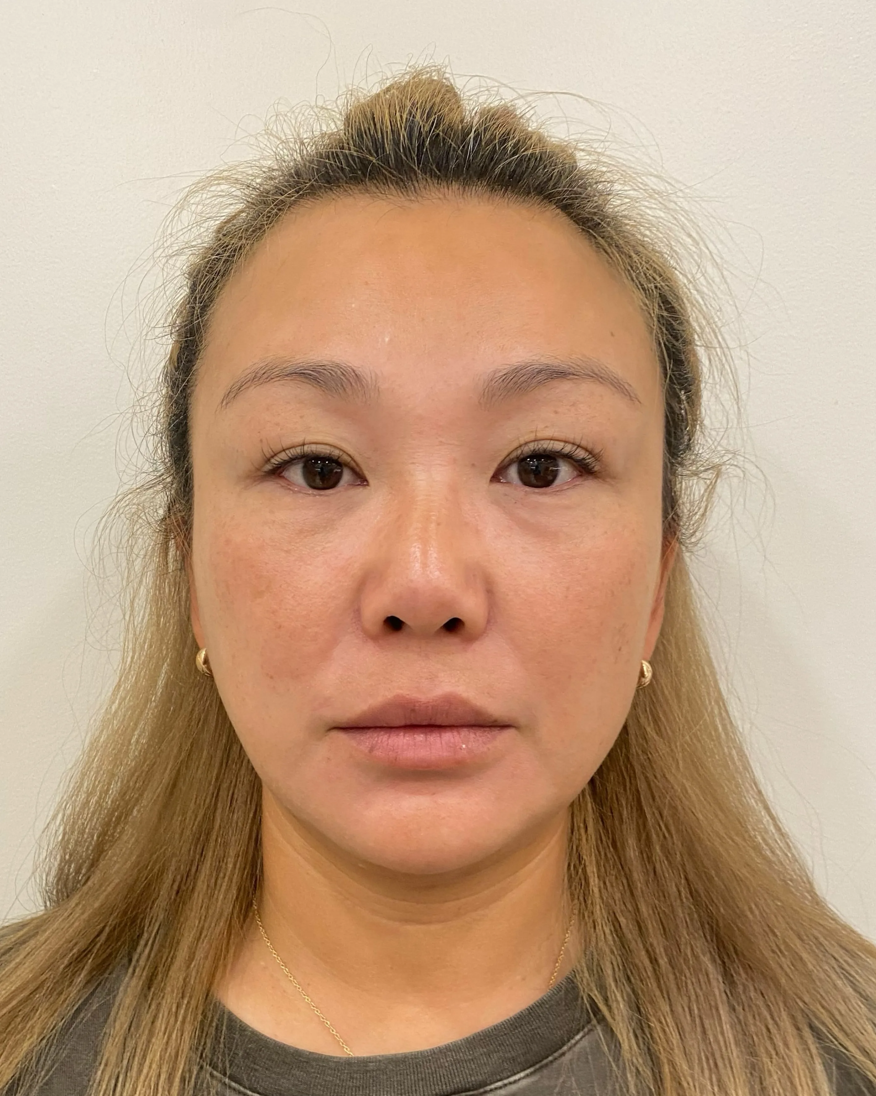 Luowei Skeletal facial contouring · before · Case 47 · Luowei Medical Aesthetics Clinic