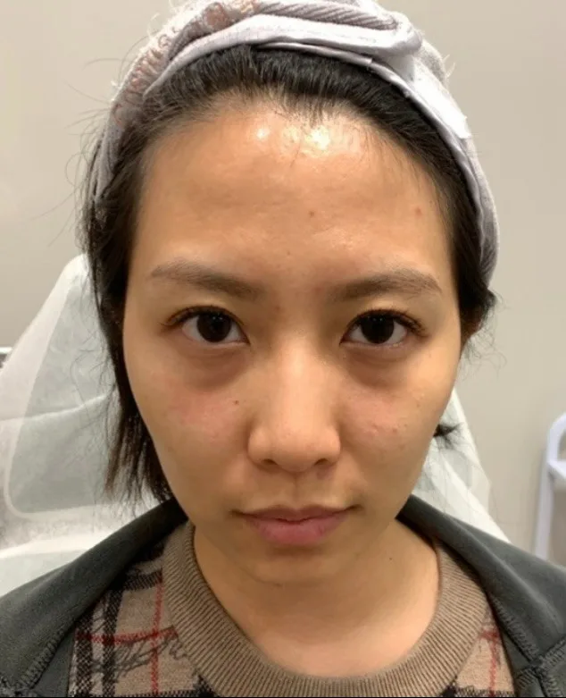 Luowei Bone-Structure Facial Sculpting Before · Case 51 · Luowei Medical Aesthetics Clinic