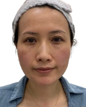 Jawline Contour, After · Case 53 · Luowei Medical Aesthetics Clinic