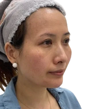 Jawline contour · after · Case 54 · Luowei Medical Aesthetics Clinic