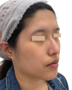 Jawline contour After · Case 55 · Luowei Medical Aesthetics Clinic