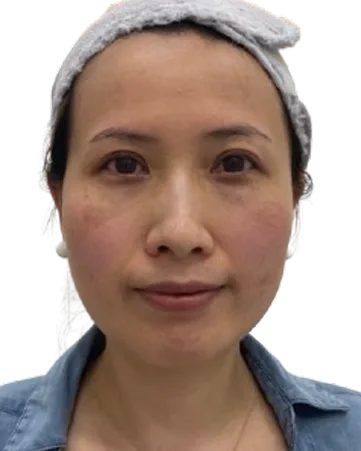 Jawline contour Before · Case 53 · Luowei Medical Aesthetics Clinic