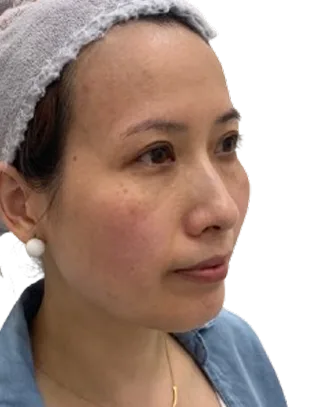 Jawline contour — Before · Case 54 · Luowei