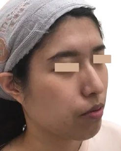 Jawline Contour — Before · Case 55 · Luowei Medical Aesthetics Clinic