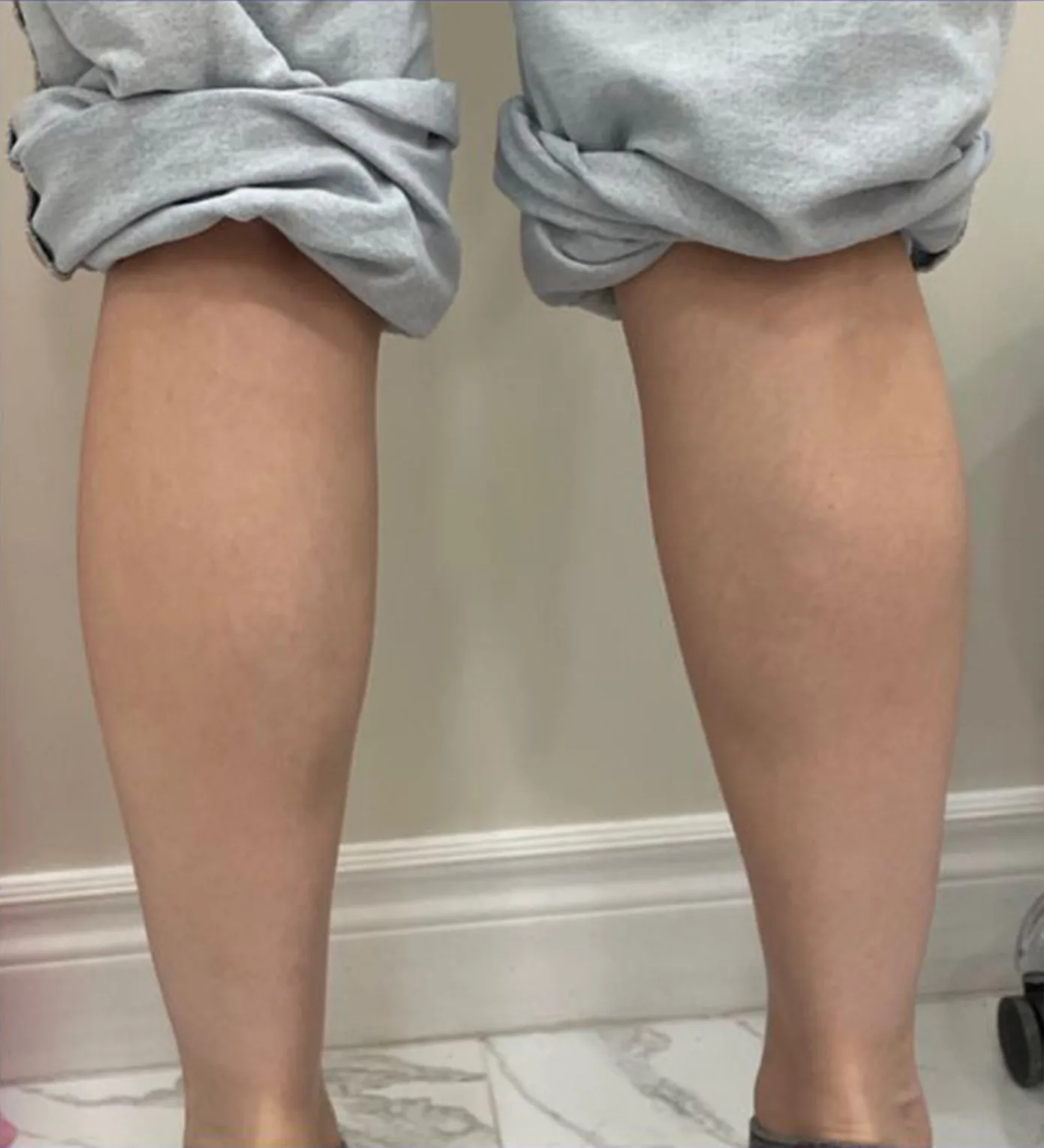 Leg Slimming — After Treatment · Case 4 · Luowei Medical Aesthetics Clinic