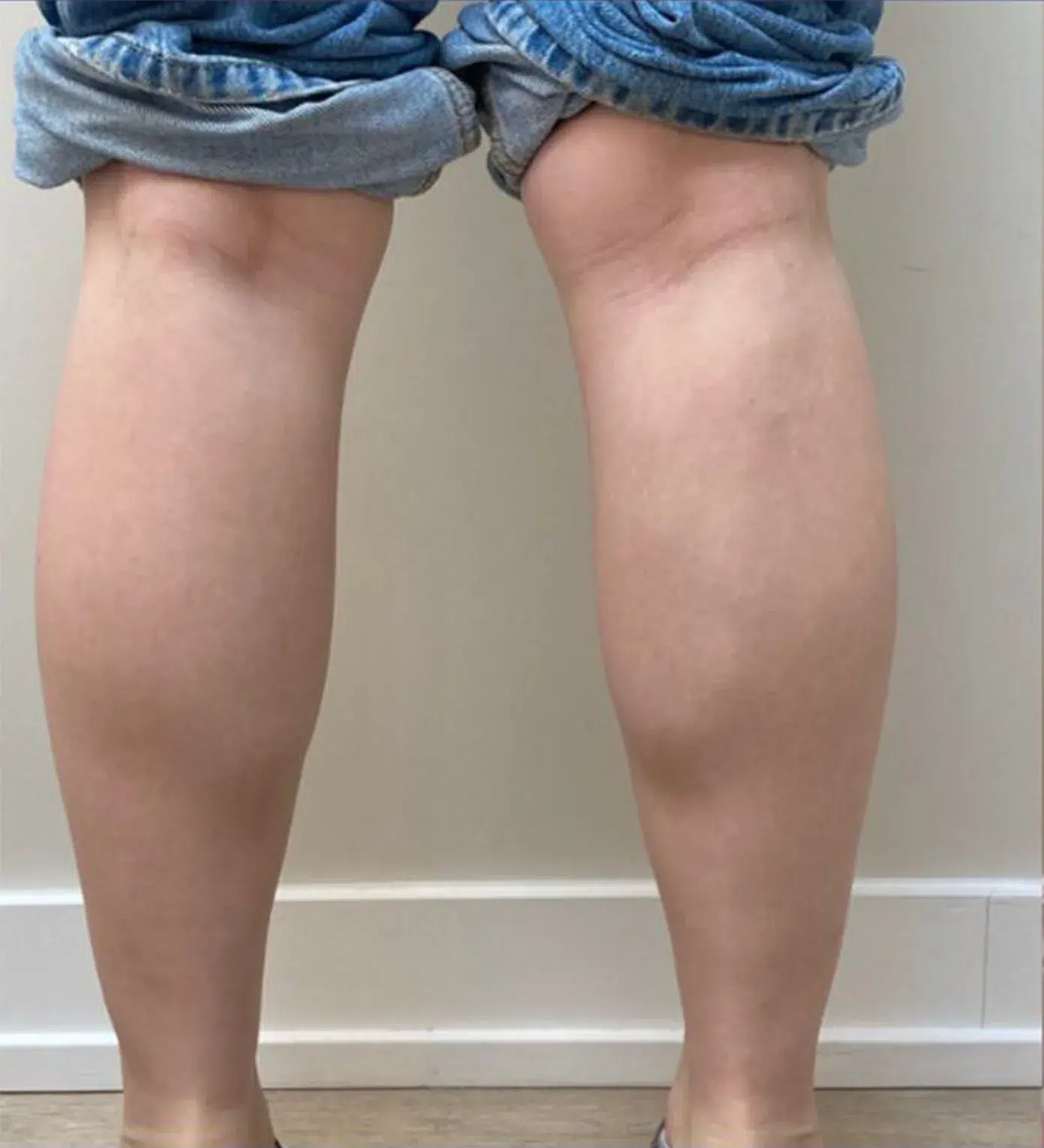 Leg Slimming — Before Treatment · Case 4 · Luowei Medical Aesthetics Clinic
