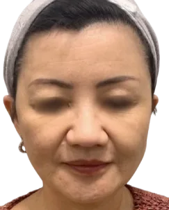 Forehead Lines — After Treatment · Case 01 · Luowei Medical Aesthetics Clinic