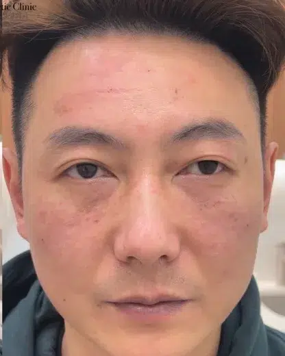 Comprehensive Wrinkle Treatment — After · Case 03 · Luowei Medical Aesthetics Clinic