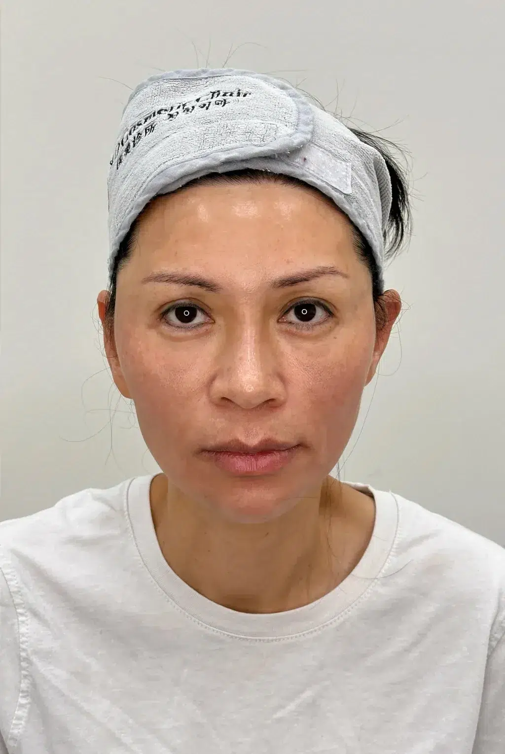 Dull Skin After · Case 05 · Luowei Medical Aesthetics Clinic