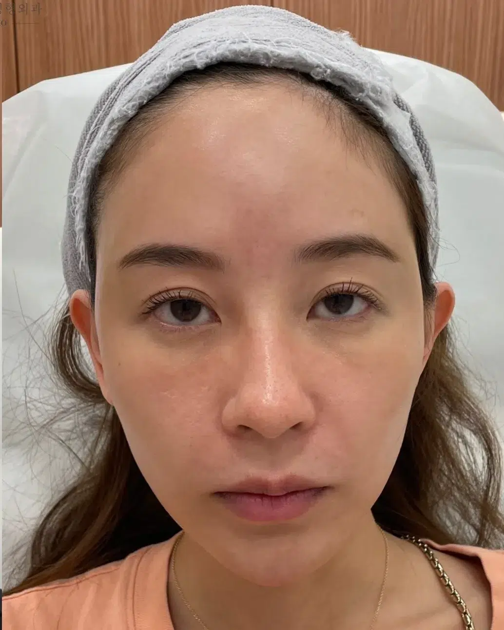 Upper Eyelid Ptosis — After Treatment · Case 08 · Luowei Medical Aesthetics Clinic