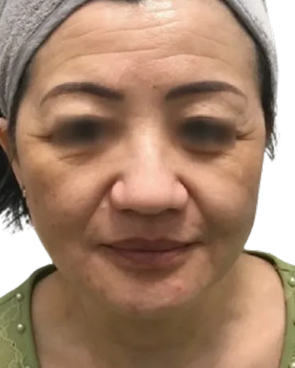 Forehead Lines — Before Treatment · Case 01 · Luowei Medical Aesthetics Clinic
