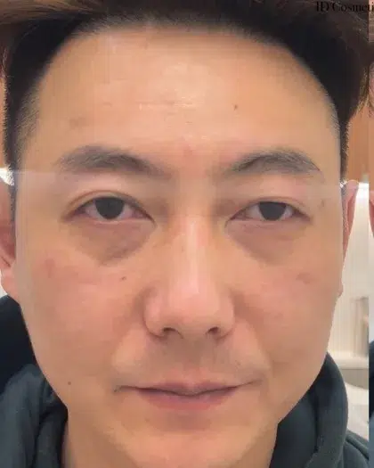 Comprehensive Wrinkle Treatment — Before · Case 03 · Luowei Medical Aesthetics Clinic