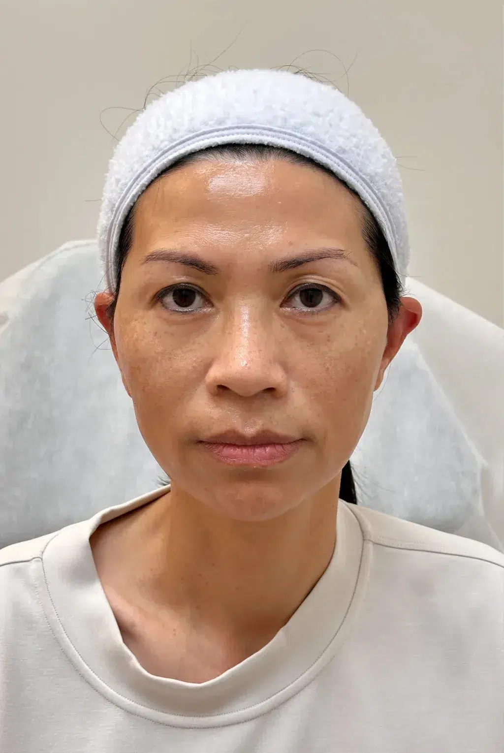 Dull Skin Before · Case 05 · Luowei Medical Aesthetics Clinic