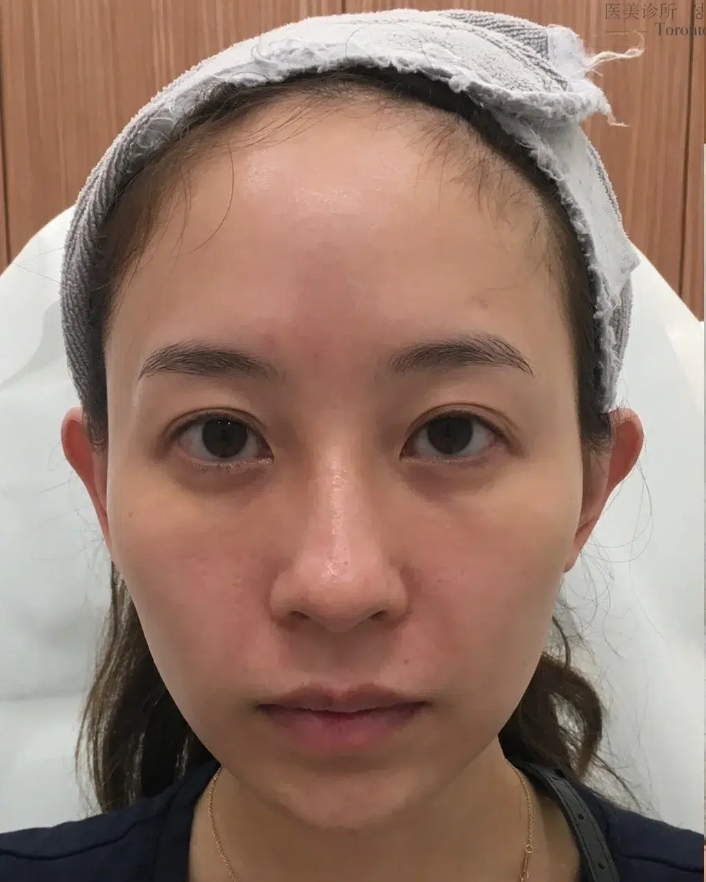 Upper Eyelid Ptosis — Before Treatment · Case 08 · Luowei Medical Aesthetics Clinic