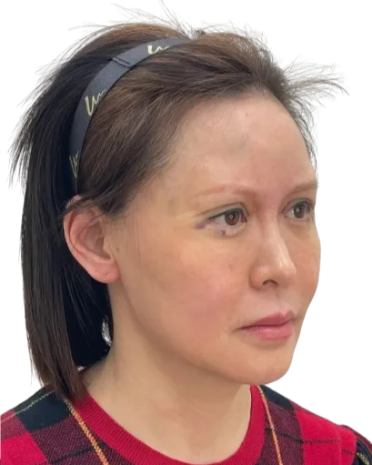 Marionette Lines / Downturned Mouth Corners — After · Case 4 · Luowei Medical Aesthetics Clinic
