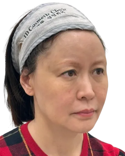 Marionette lines / downturned mouth corners — Before · Case 4 · Luowei