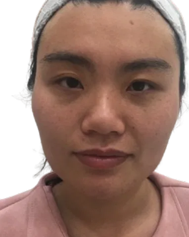 Masseter Hypertrophy · Post-Treatment · Case 01 · Luowei Medical Aesthetics Clinic