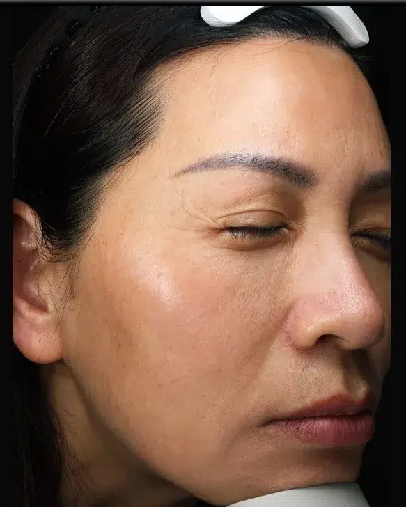 Melasma After Treatment · Case 09 · Luowei