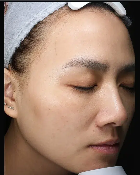 Melasma After Treatment · Case 13 · Luowei Medical Aesthetics Clinic