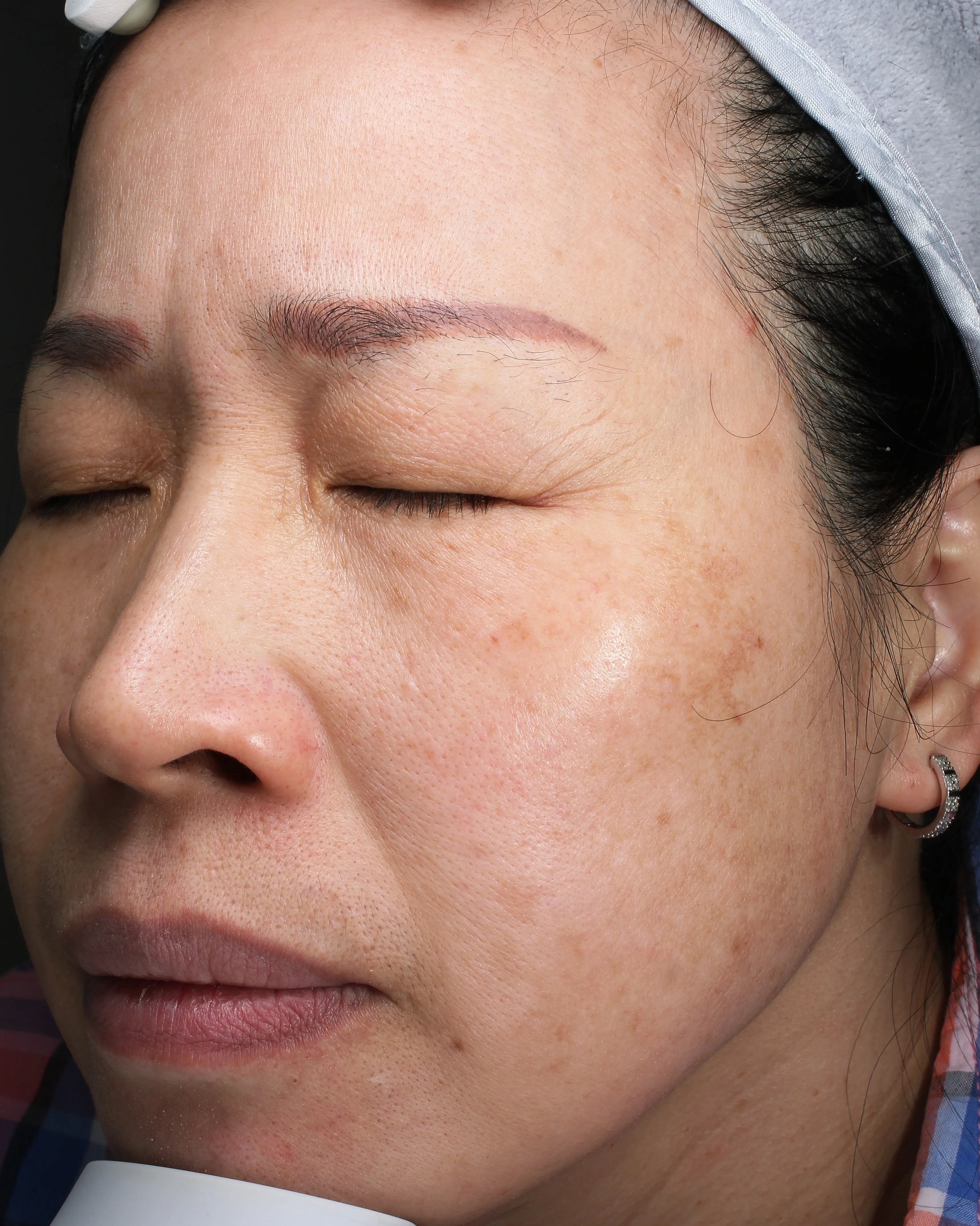 Melasma After Treatment · Case 17 · Luowei