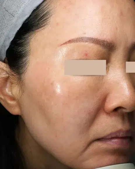 Melasma After Treatment · Case 18 · Luowei Medical Aesthetics Clinic
