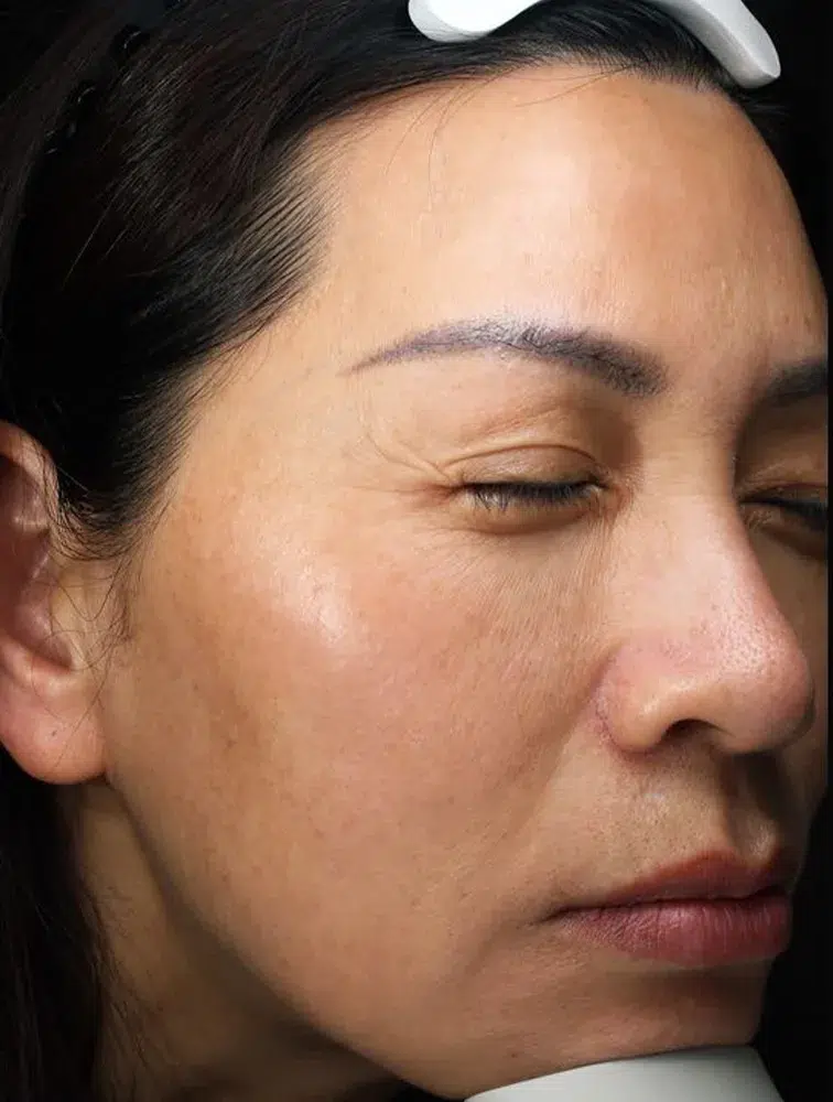 Melasma After Treatment · Case 20 · Luowei Medical Aesthetics Clinic